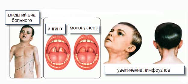 Крапивница & Ангионевротический отек