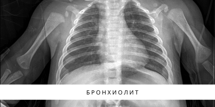 атопический дерматит клинические рекомендации