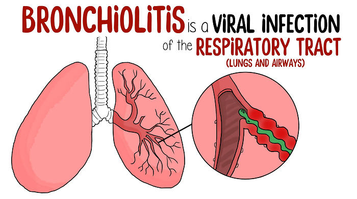 вирусный бронхиолит