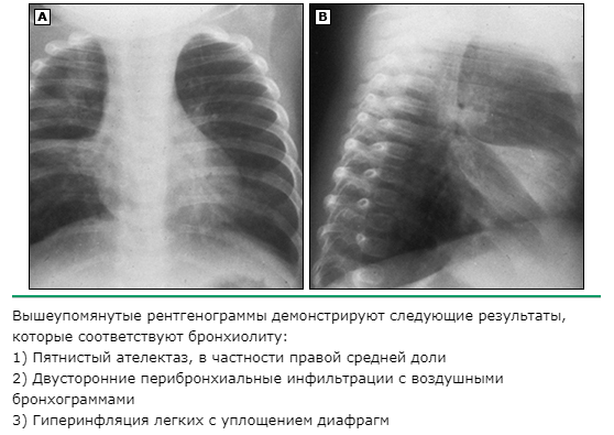 рентгенография бронхиолита